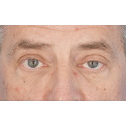 Ptosis Repair Before & After Patient #618