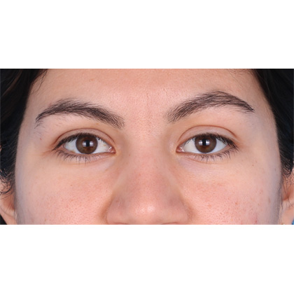 Ptosis Repair Before & After Patient #619
