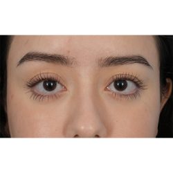 Ptosis Repair Before & After Patient #620