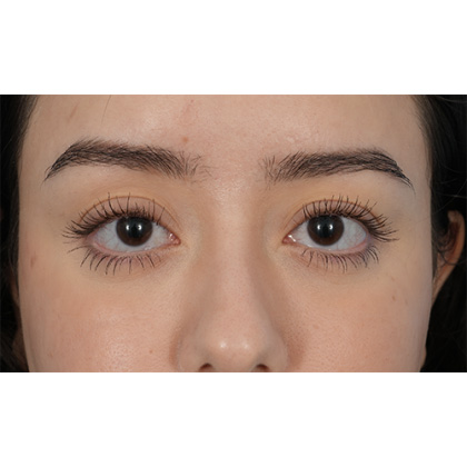 Ptosis Repair Before & After Patient #620