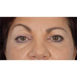Ptosis Repair Before & After Patient #621