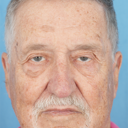Ptosis Repair Before & After Patient #622