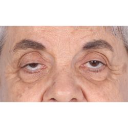 Ptosis Repair Before & After Patient #626
