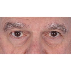 Lesion Removal Before & After Patient #357
