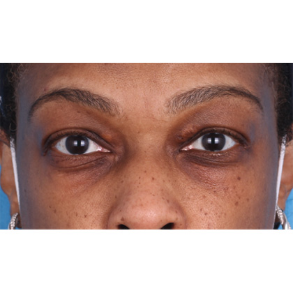 Upper Blepharoplasty Before & After Patient #693