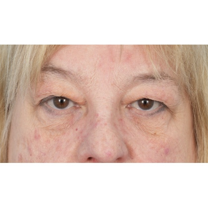 Upper Blepharoplasty Before & After Patient #728