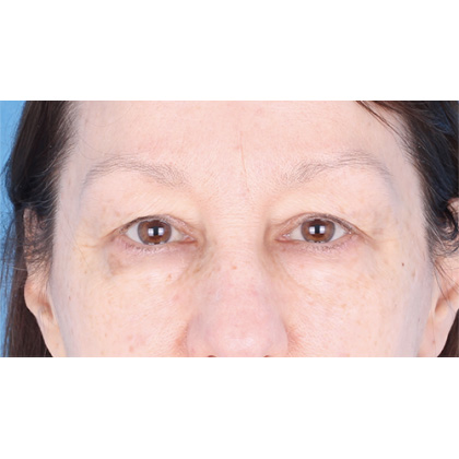 Upper Blepharoplasty Before & After Patient #695