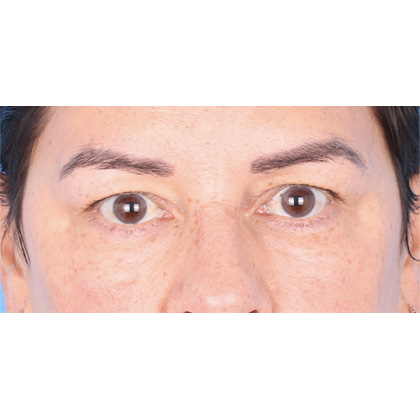 Upper Blepharoplasty Before & After Patient #696