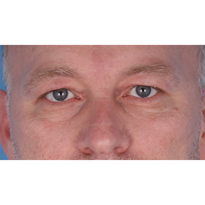 Upper Blepharoplasty Before & After Patient #697