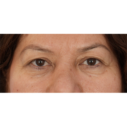 Upper Blepharoplasty Before & After Patient #701