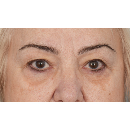 Upper Blepharoplasty Before & After Patient #702