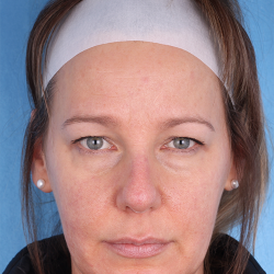 Upper Blepharoplasty Before & After Patient #692