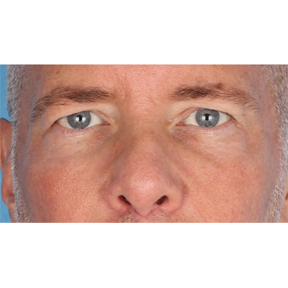 Upper Blepharoplasty Before & After Patient #699