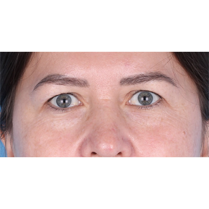 Upper Blepharoplasty Before & After Patient #698