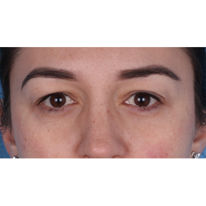 Upper Blepharoplasty Before & After Patient #700