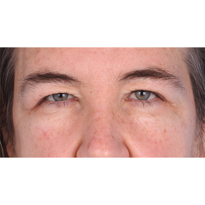 Upper Blepharoplasty Before & After Patient #813