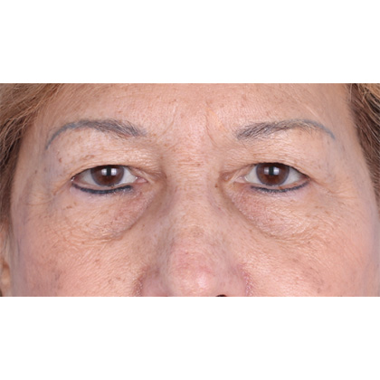 Upper Blepharoplasty Before & After Patient #814