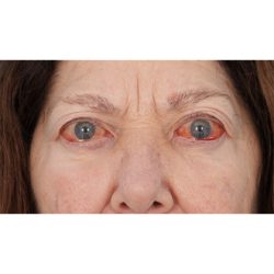 Tepezza Before & After Patient #829