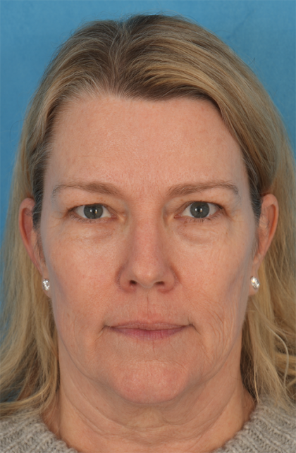 Four Lid Blepharoplasty Before & After Patient #394