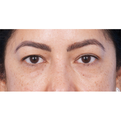 Four Lid Blepharoplasty Before & After Patient #397