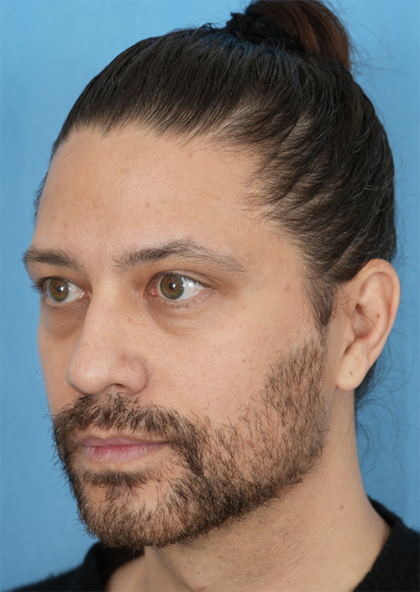 Lower Blepharoplasty Before & After Patient #527