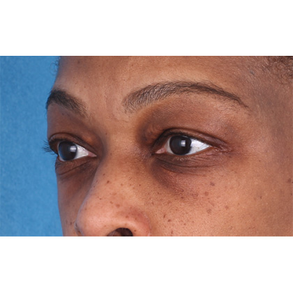 Upper Blepharoplasty Before & After Patient #693