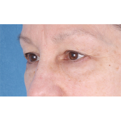 Upper Blepharoplasty Before & After Patient #695