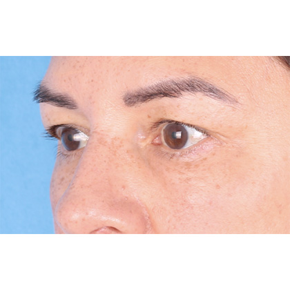 Upper Blepharoplasty Before & After Patient #696