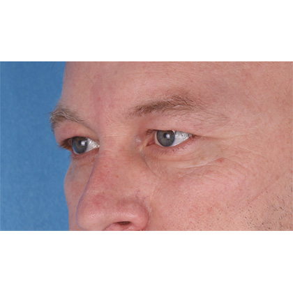 Upper Blepharoplasty Before & After Patient #697