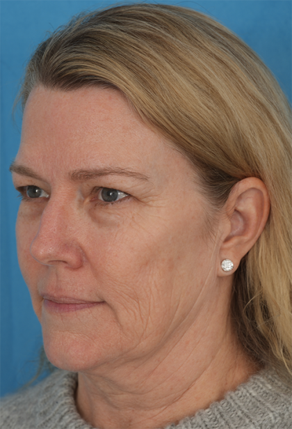 Four Lid Blepharoplasty Before & After Patient #394
