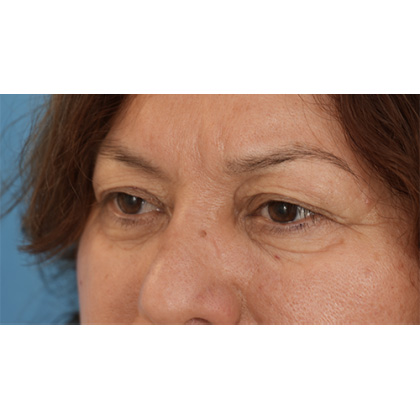 Upper Blepharoplasty Before & After Patient #701