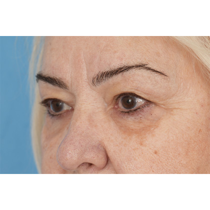 Upper Blepharoplasty Before & After Patient #702