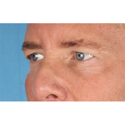 Upper Blepharoplasty Before & After Patient #699