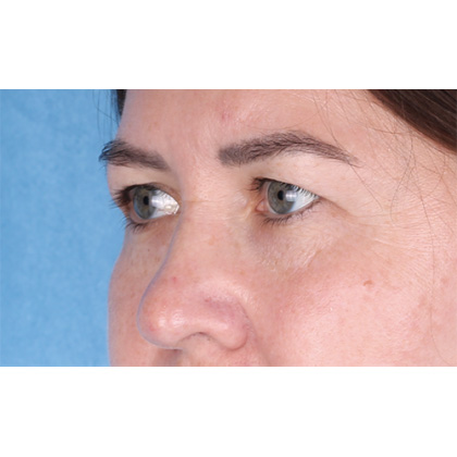 Upper Blepharoplasty Before & After Patient #698