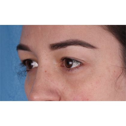 Upper Blepharoplasty Before & After Patient #700