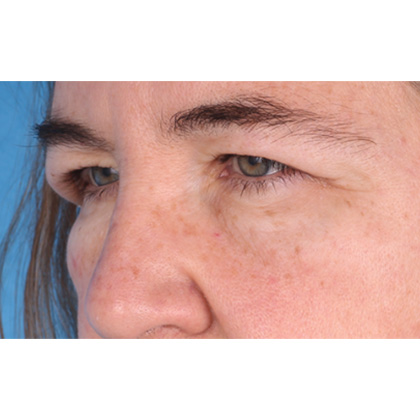 Upper Blepharoplasty Before & After Patient #813