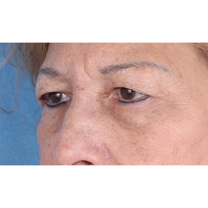 Upper Blepharoplasty Before & After Patient #814