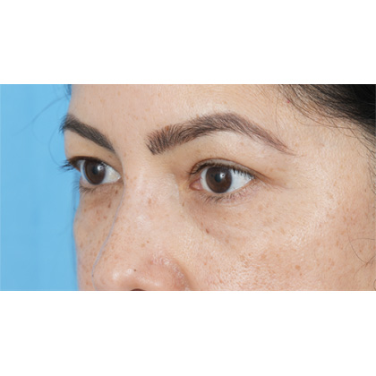 Four Lid Blepharoplasty Before & After Patient #397