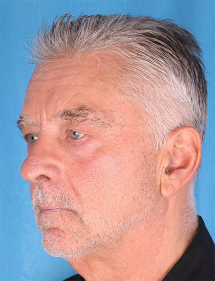 Four Lid Blepharoplasty Before & After Patient #396