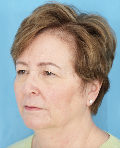 Four Lid Blepharoplasty Before & After Patient #401