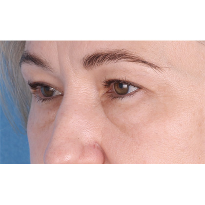 Four Lid Blepharoplasty Before & After Patient #399