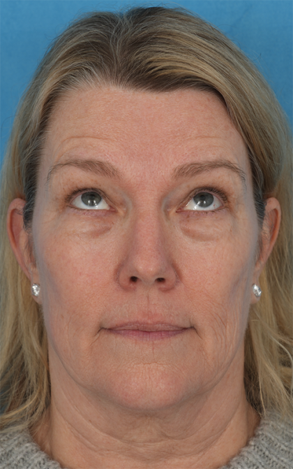 Four Lid Blepharoplasty Before & After Patient #394