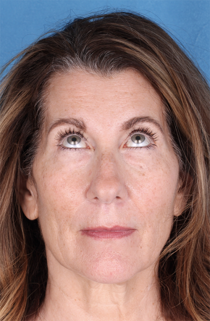 Lower Blepharoplasty Before & After Patient #525