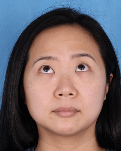 Lower Blepharoplasty Before & After Patient #524