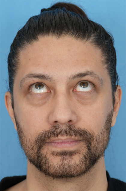 Lower Blepharoplasty Before & After Patient #527