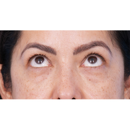 Four Lid Blepharoplasty Before & After Patient #397