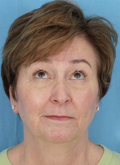 Four Lid Blepharoplasty Before & After Patient #401