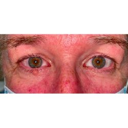 Lesion Removal Before & After Patient #356