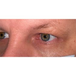 Lesion Removal Before & After Patient #358