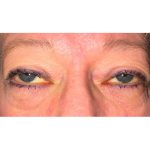 Ptosis Repair Before & After Patient #624